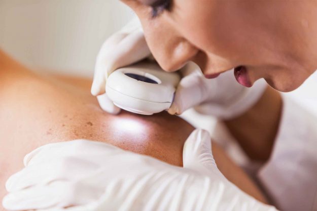 skin-cancer-moles-information-nz